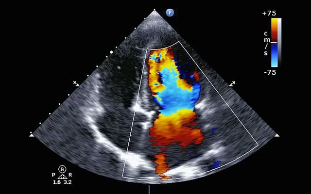 Echocardiograms
