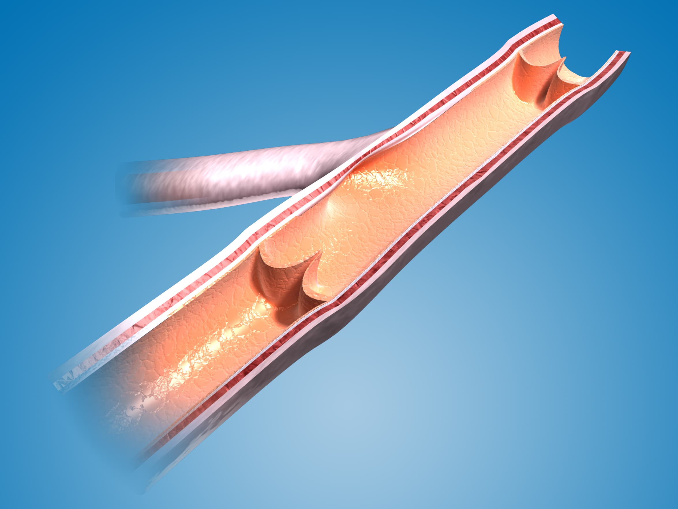 Venous Insufficiency